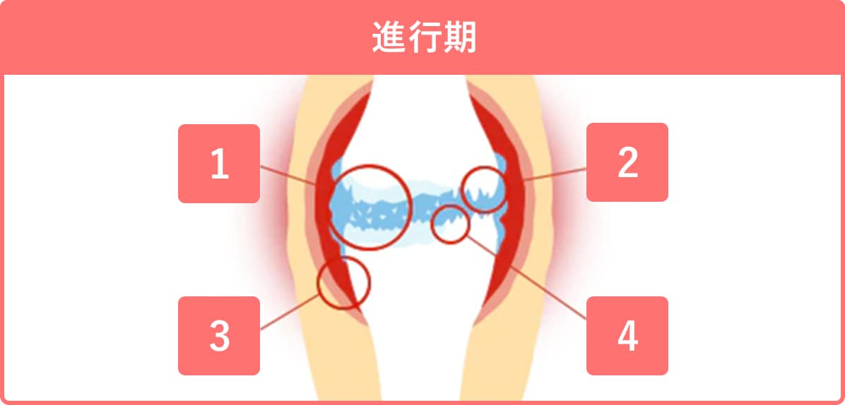 進行期